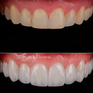 lentes-de-contato-03