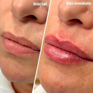 preenchimento-labial-01