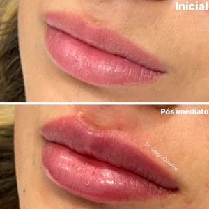 preenchimento-labial-03